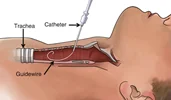 تراکئوستومی پرکوتانئوس Percutaneous Tracheostomy