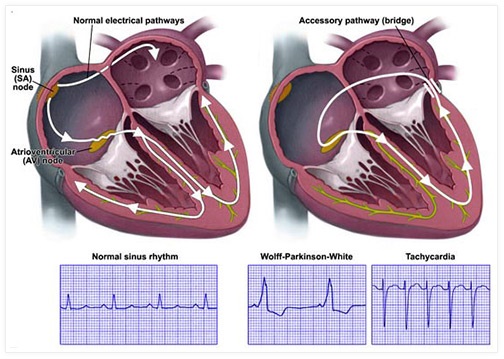 داروهای مورد استفاده در آریتمی های حین احیای قلبی ریوی