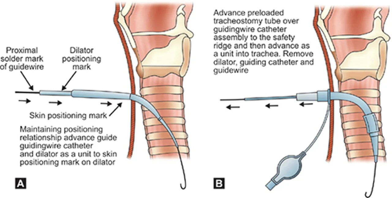 تراکئوستومی پرکوتانئوس Percutaneous Tracheostomy