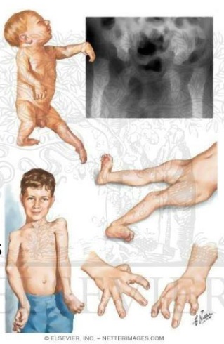 آرتروگریپوز مولتی‌پلکس کانجنیتا (AMC): Arthrogryposis Multiplex Congenita