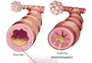 برونکواسپاسم در طی بیهوشی عمومی