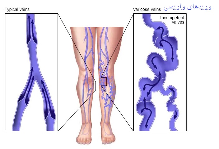 وريدهاي واريسي