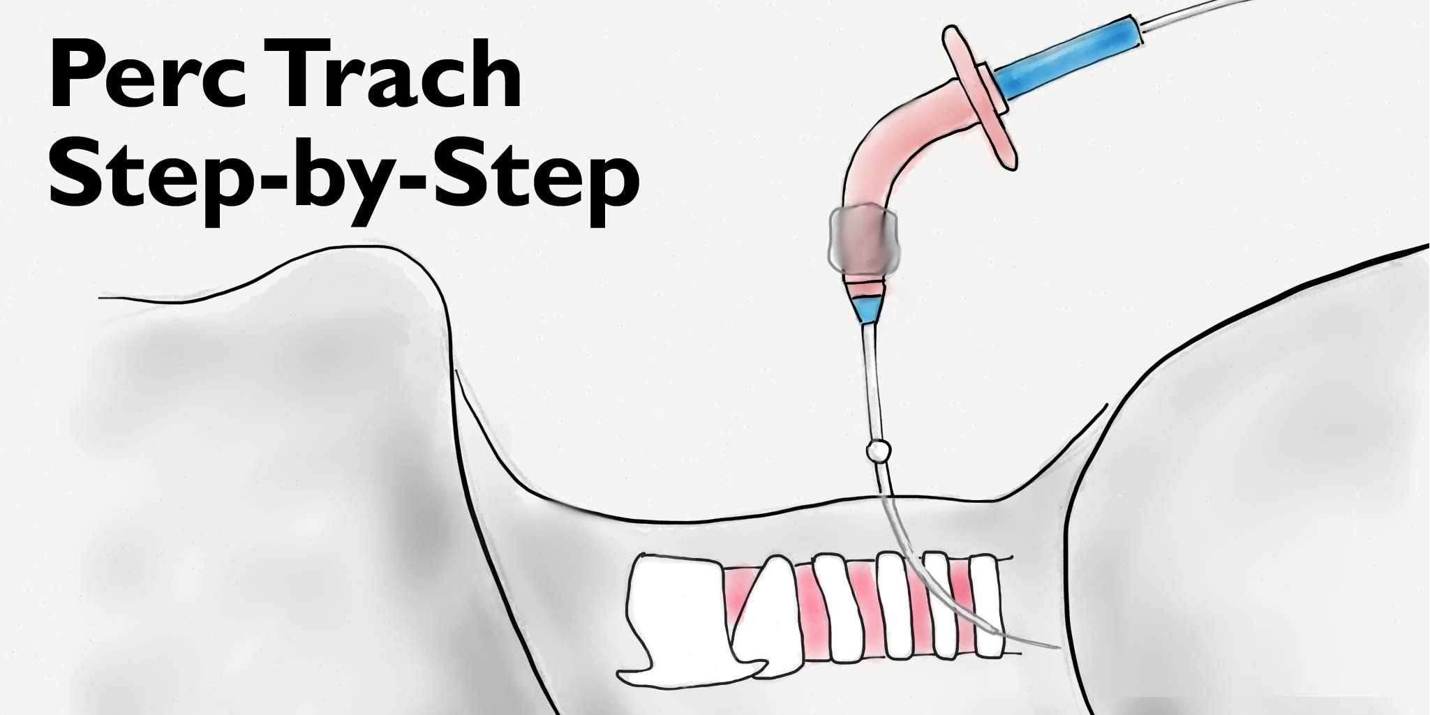 فیلم انجام تراکئوستومی پرکوتانئوس