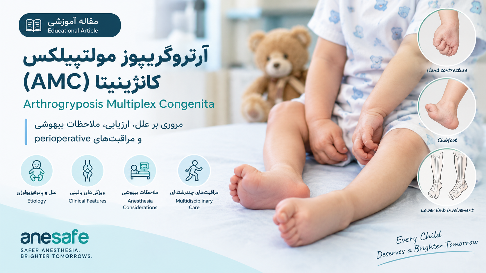 آرتروگریپوز مولتی‌پلکس کانجنیتا (AMC): Arthrogryposis Multiplex Congenita