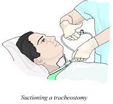 مراقبت و ساکشن  لوله تراکئوستومی
